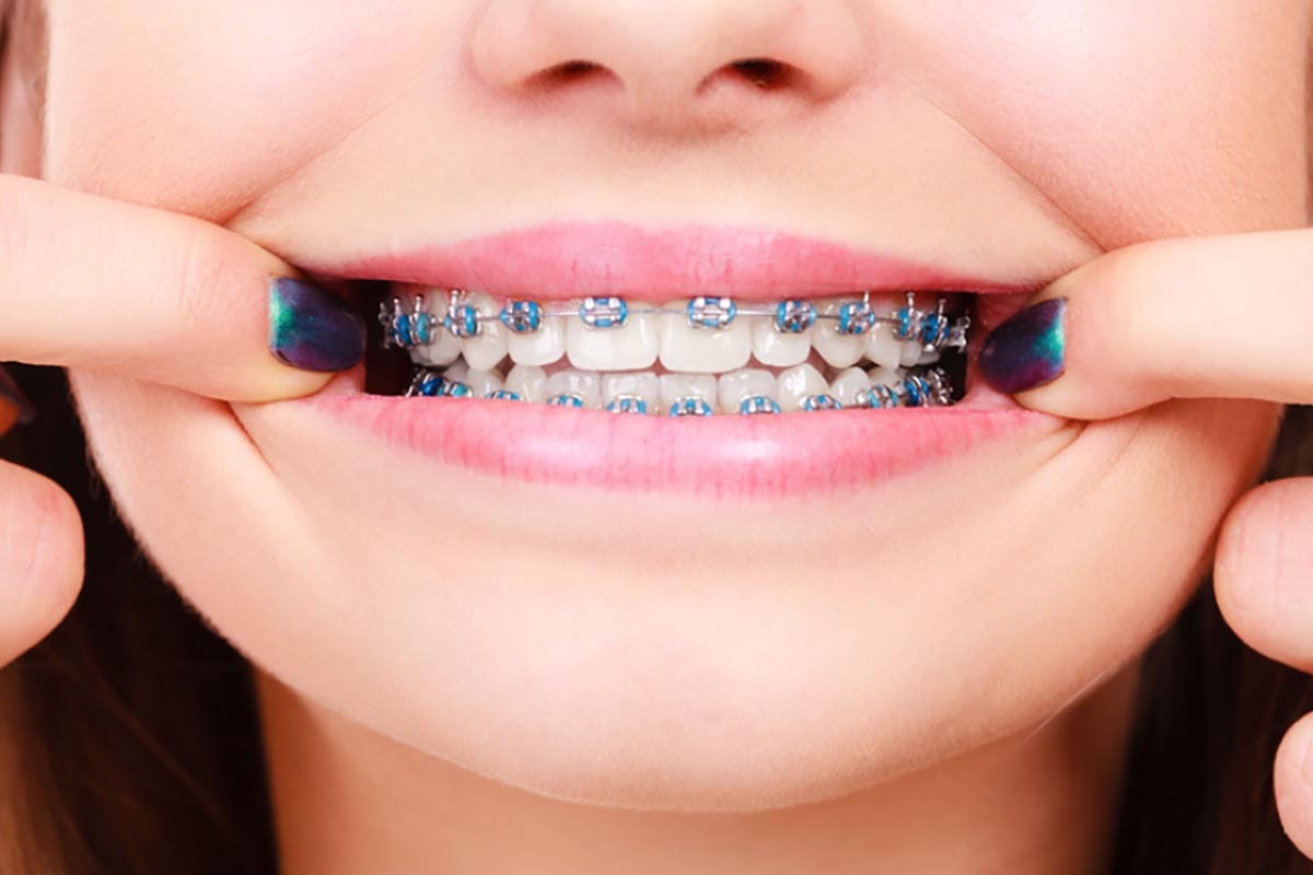 Loose, Broken, or Poking Orthodontic Appliance? Here&rsquo;s How to Fix It