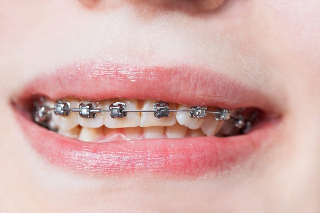 Damon Smile Self-ligating Braces